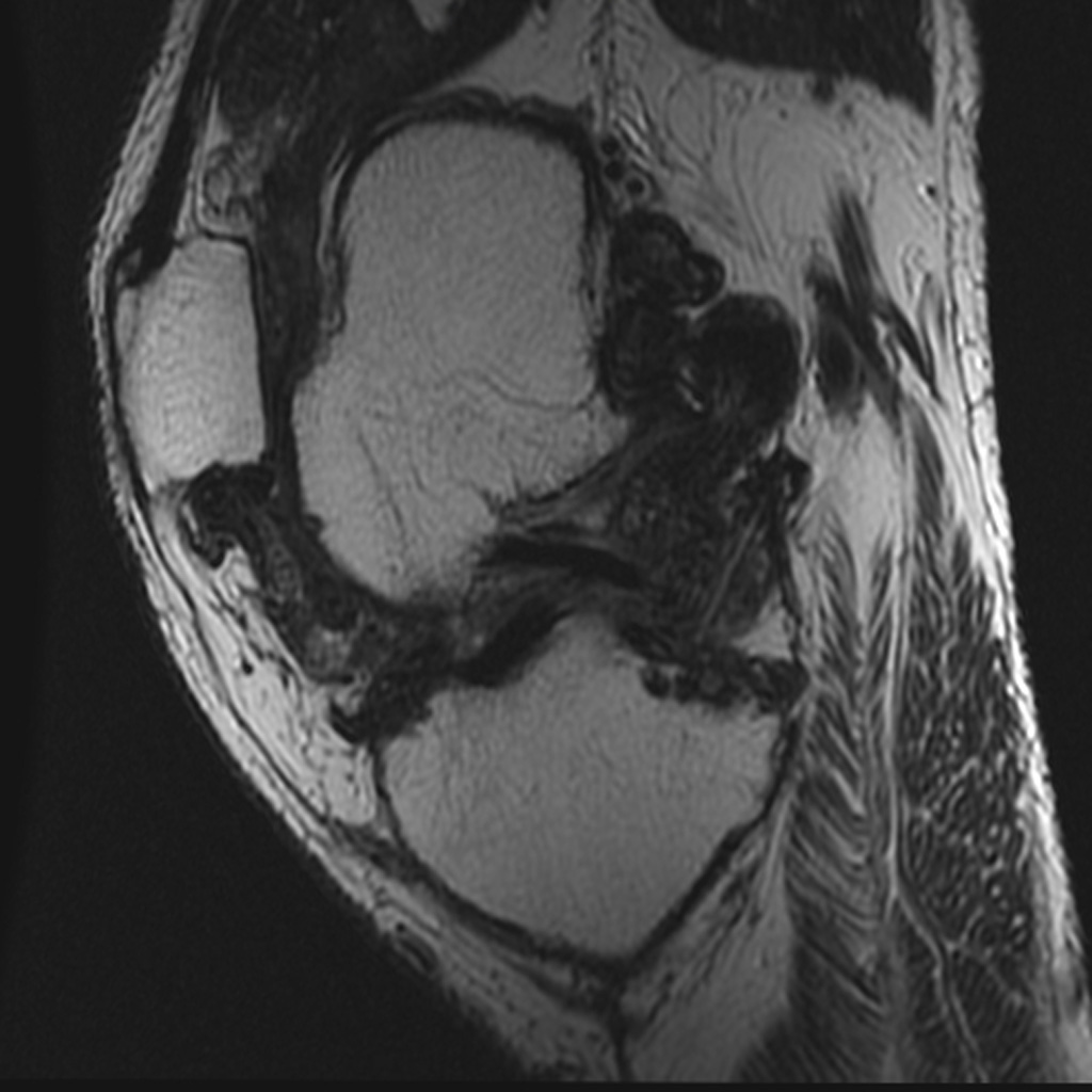 new research for pigmented villonodular synovitis