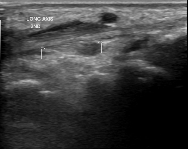 Foreign body in hand | Image | Radiopaedia.org