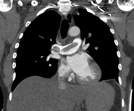 Saddle pulmonary embolism | Radiology Case | Radiopaedia.org