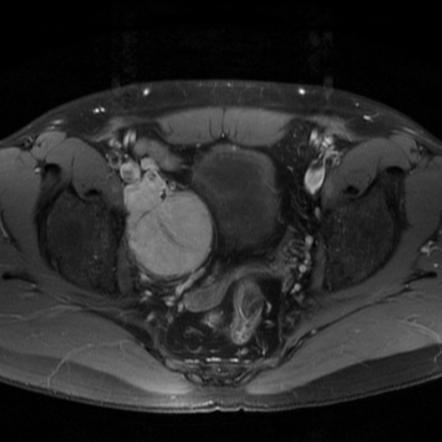 Pelvic non-Hodgkin lymphoma | Radiology Case | Radiopaedia.org