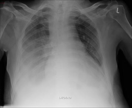 Pleural effusion | Radiology Case | Radiopaedia.org