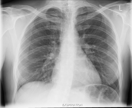 Pneumothorax | Radiology Case | Radiopaedia.org