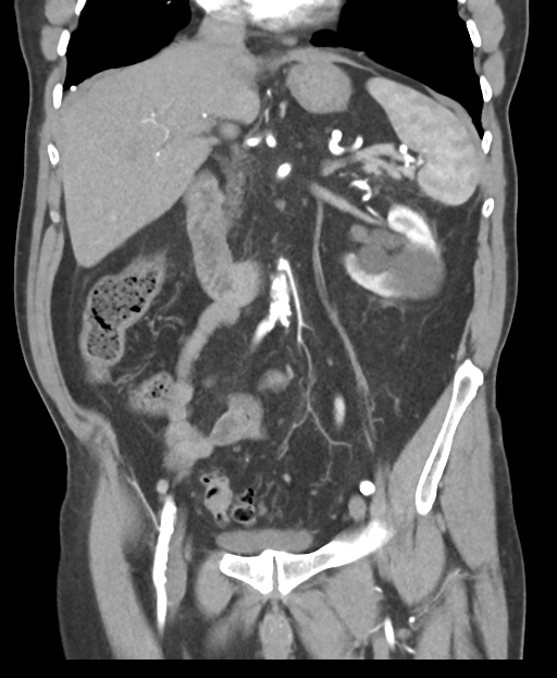 Large bowel watershed ischemia | Image | Radiopaedia.org