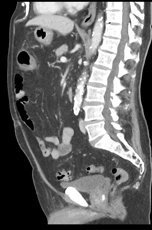 large-bowel-watershed-ischemia-image-radiopaedia