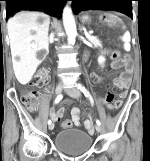 Common Bile Duct Stone And Lung Cancer 