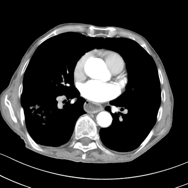 mesothelioma supportive treatment