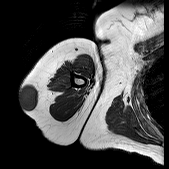 Epidermoid Cyst In The Upper Arm Image