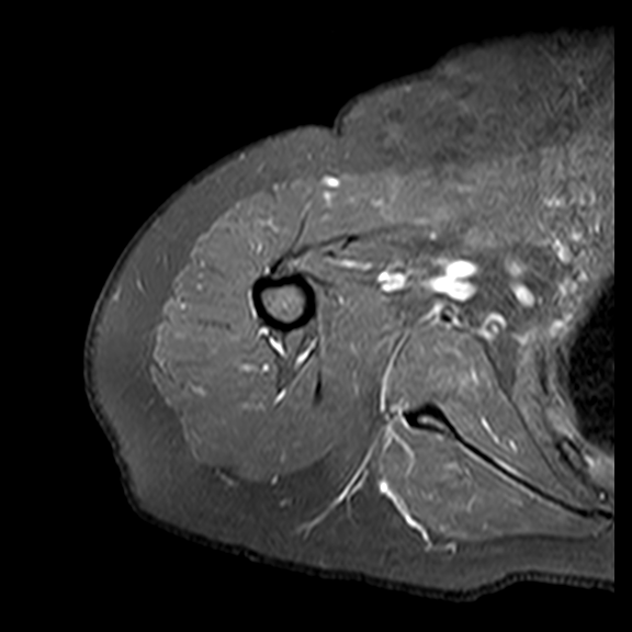 Epidermoid Cyst In The Upper Arm Image