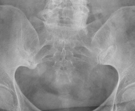 Chronic sacroiliitis | Radiology Case | Radiopaedia.org