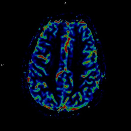 Diffuse astrocytoma NOS (