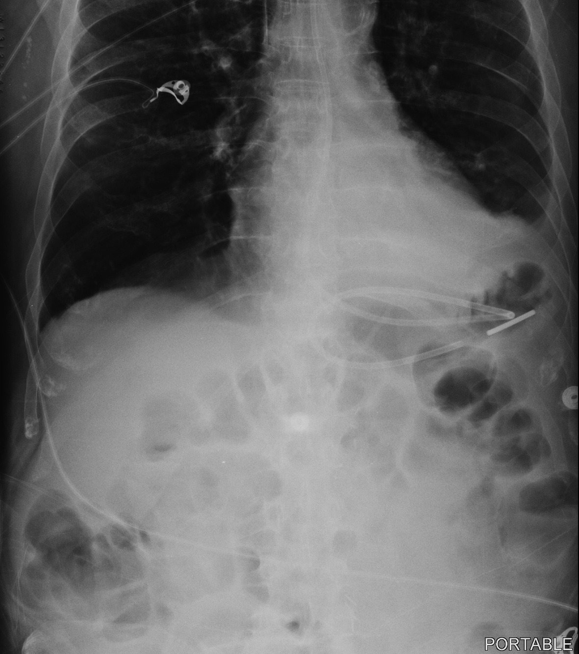 Dobhoff (nasogastric tube) tube | Image | Radiopaedia.org