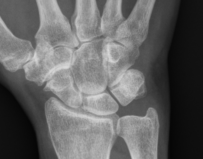 Scaphotrapeziotrapezoid Stt Osteoarthritis Image