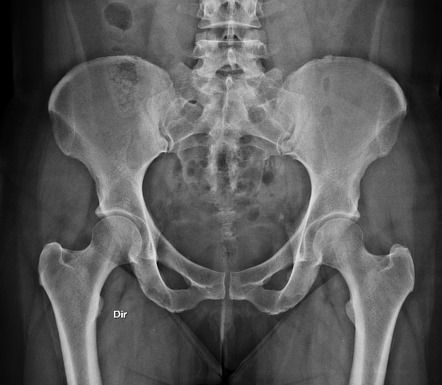 Pelvic radiograph: normal | Radiology Case | Radiopaedia.org