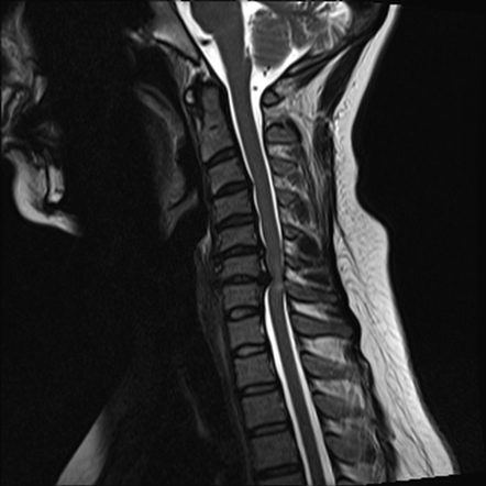 Compressive myelopathy | Radiology Reference Article | Radiopaedia.org