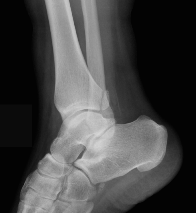 Posterior Malleolus Fracture Image 8508