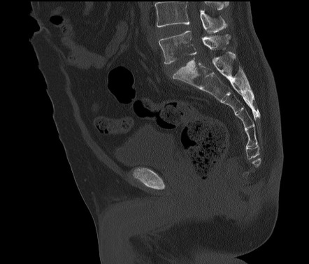 Spondylodiscitis | Radiology Reference Article | Radiopaedia.org