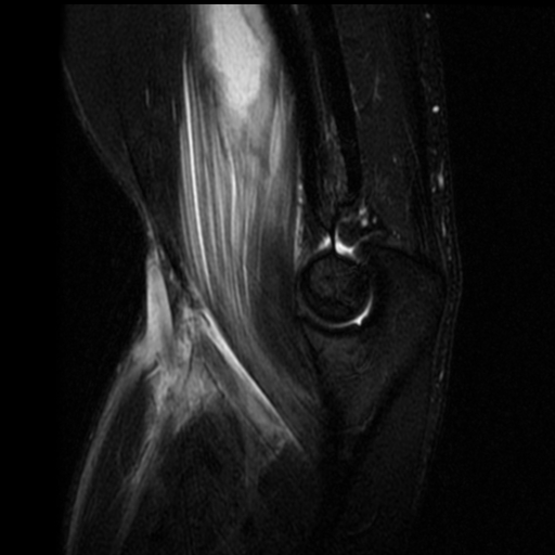 Brachialis muscle injury | Image | Radiopaedia.org