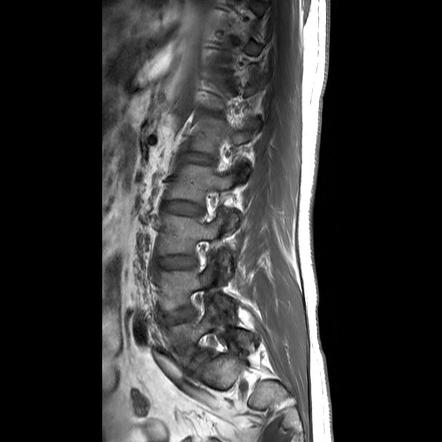 Ankylosing spondylitis | Radiology Reference Article | Radiopaedia.org