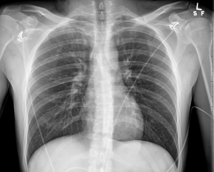 Sternal fracture | Radiology Case | Radiopaedia.org