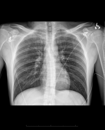 Sternal fracture | Radiology Case | Radiopaedia.org