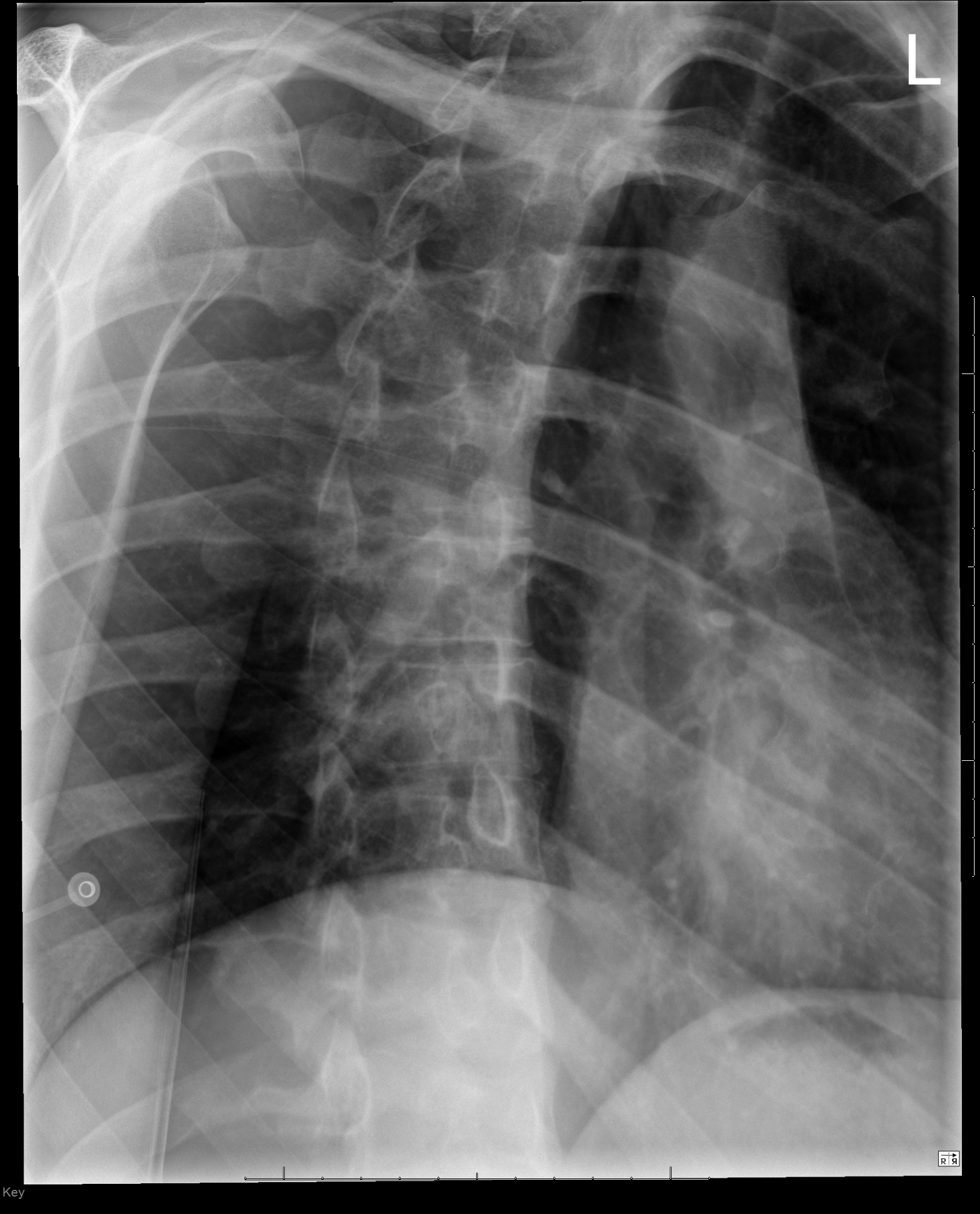 Sternal Fracture Image Radiopaedia Org