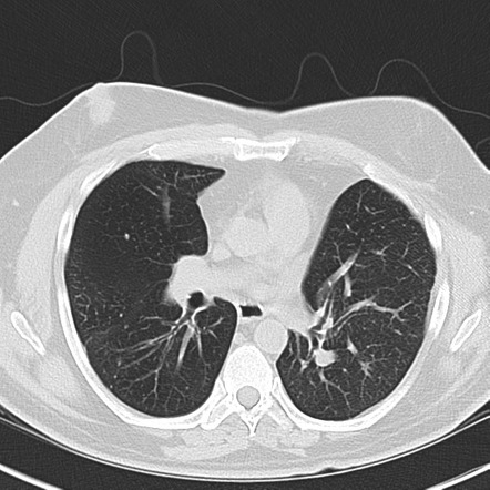 Broncholith | Radiology Reference Article | Radiopaedia.org