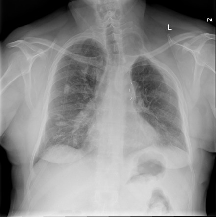 Tuberculous broncholithiasis | Radiology Case | Radiopaedia.org