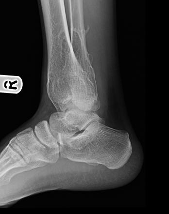 Hereditary multiple exostoses - diaphyseal aclasis | Radiology Case ...