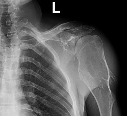 Hereditary Multiple Exostoses 