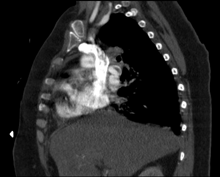 Pulmonary embolism | Image | Radiopaedia.org