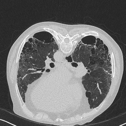 Idiopathic pulmonary fibrosis and lung cancer | Image | Radiopaedia.org