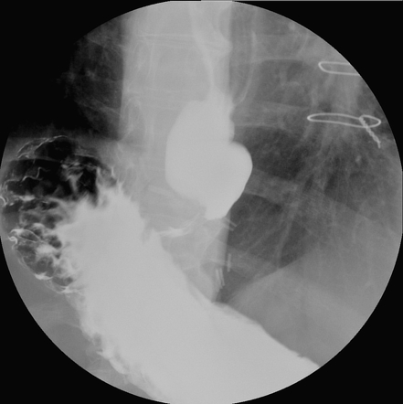 Esophageal Myotomy 