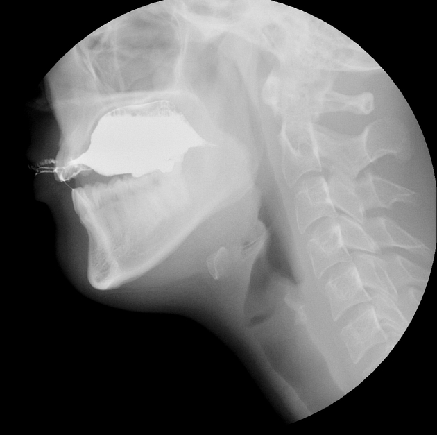 Normal Barium Swallow Anatomy