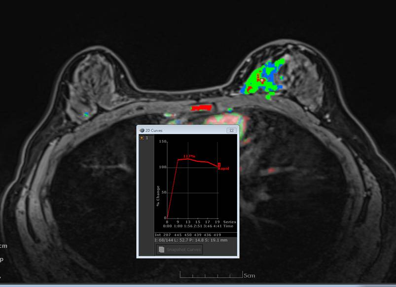 High Grade Ductal Carcinoma In Situ: MRI Findings | Image | Radiopaedia.org