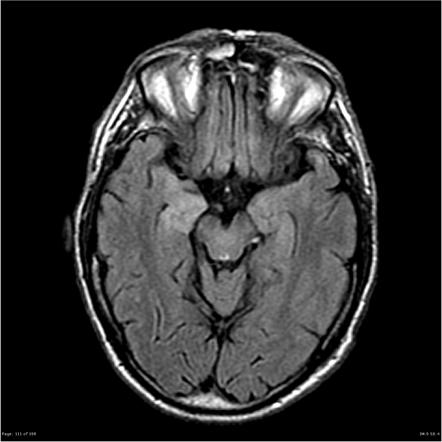 Autoimmune encephalitis | Radiology Reference Article | Radiopaedia.org