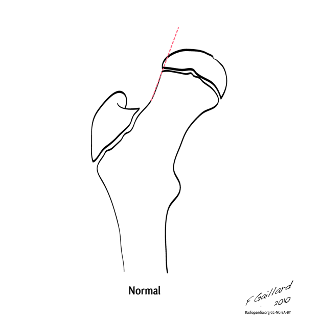 Slipped upper femoral epiphysis | Image | Radiopaedia.org