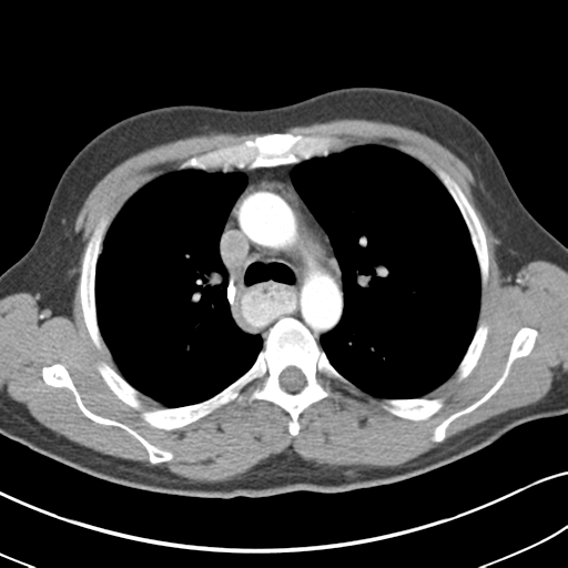 Achalasia of the cardia | Image | Radiopaedia.org