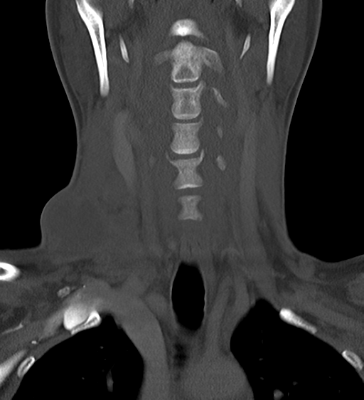 Scrofula | Image | Radiopaedia.org