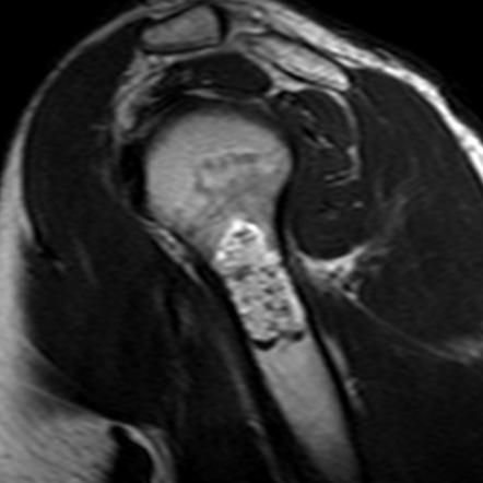 Enchondroma | Radiology Reference Article | Radiopaedia.org