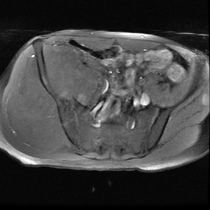 Ewing Sarcoma Pelvis Image