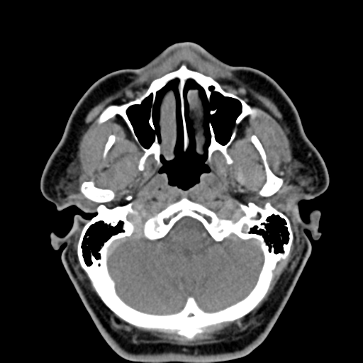 Map Quiz: Mandibula (imesap - mandibula - huesos)