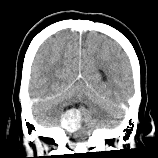 Choroid plexus papilloma | Image | Radiopaedia.org