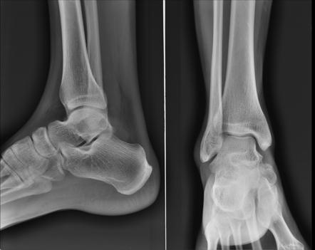 Ankle hemangioma | Image | Radiopaedia.org