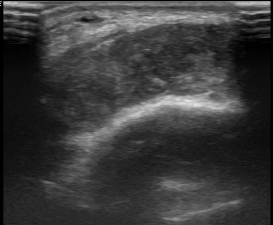 Ankle hemangioma | Image | Radiopaedia.org