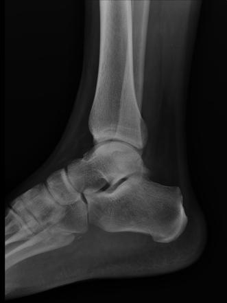 Hemangioma of foot | Radiology Case | Radiopaedia.org