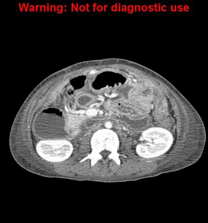 Sma syndrome что