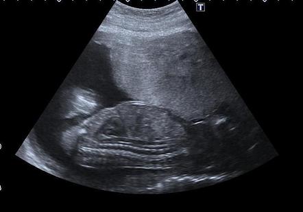 Thanatophoric dysplasia: antenatal ultrasound | Image | Radiopaedia.org