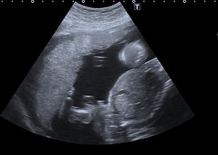 Thanatophoric dysplasia: antenatal ultrasound | Image | Radiopaedia.org