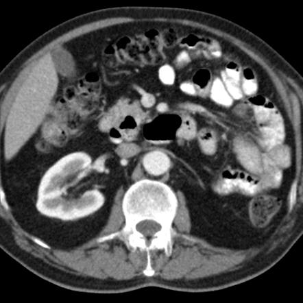 Duodenal diverticula | Image | Radiopaedia.org