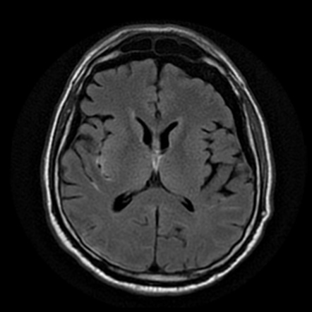 Diffuse axonal injury | Image | Radiopaedia.org